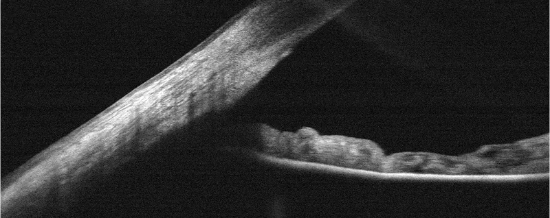 Tomografia do segmento anterior mostrando o ângulo de drenagem