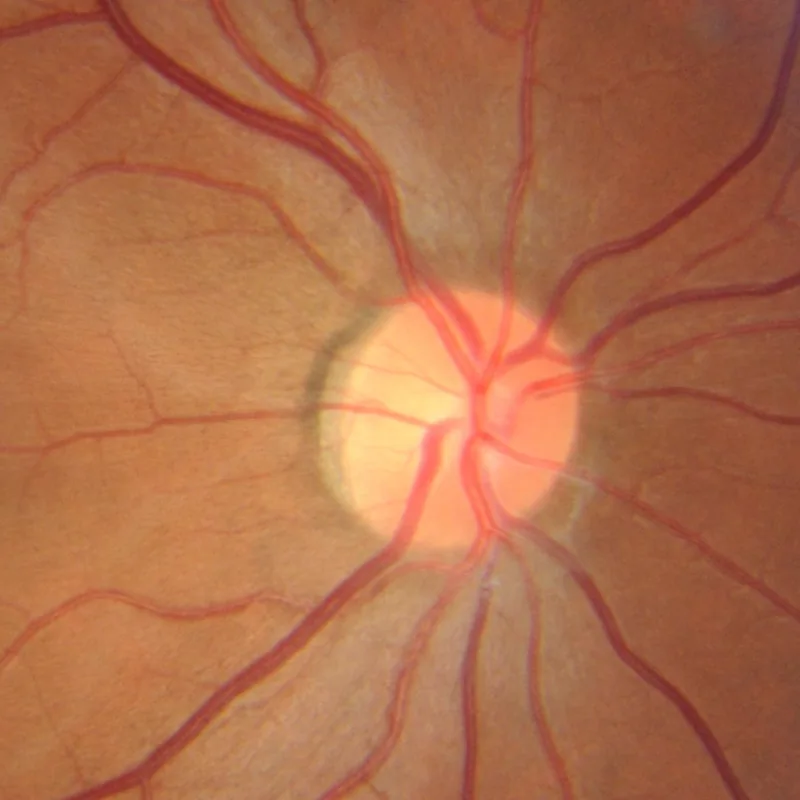 Retinografia de um nervo óptico saudável